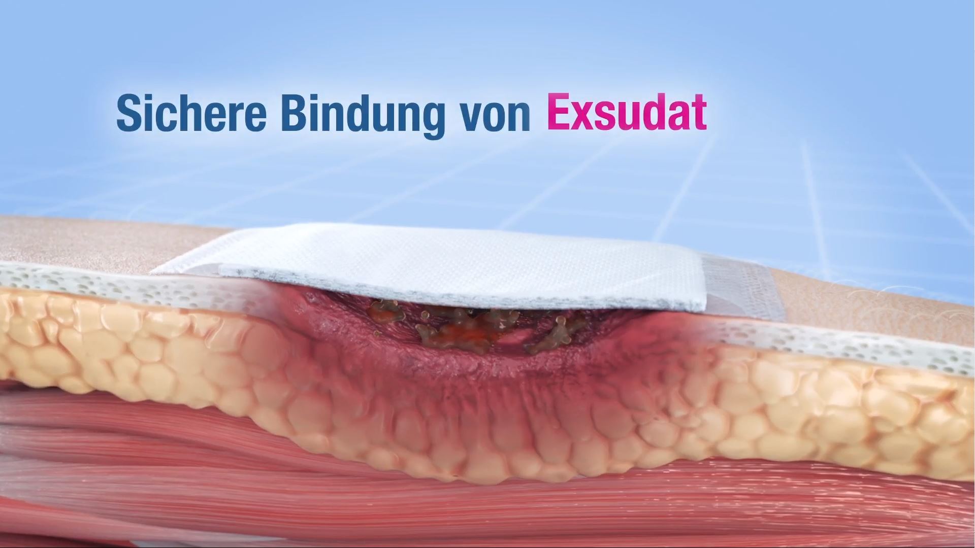 Die Wirkweise von Cutimed Sorbion erklärt Die Wirkweise von Cutimed Sorbion erklärt